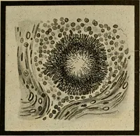 An illustration from Grundriss und Atlas der allgemeinen Chirurgie (1905)