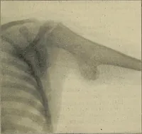 Picture 82 of 110 from Grundriss und Atlas der allgemeinen Chirurgie (1905), leaf 397