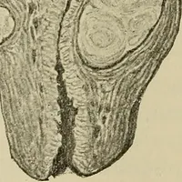 Picture 88 of 110 from Grundriss und Atlas der allgemeinen Chirurgie (1905), leaf 412