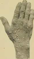 Picture 89 of 110 from Grundriss und Atlas der allgemeinen Chirurgie (1905), leaf 413
