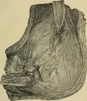 An illustration from Grundriss und Atlas der allgemeinen Chirurgie (1905)