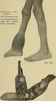 Picture 98 of 110 from Grundriss und Atlas der allgemeinen Chirurgie (1905), leaf 429