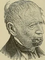 An illustration from Grundriss und Atlas der allgemeinen Chirurgie (1905)