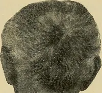An illustration from Grundriss und Atlas der allgemeinen Chirurgie (1905)