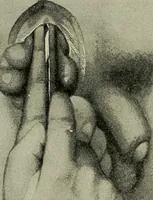 Picture 113 of 116 from Grundriss und Atlas der allgemeinen Chirurgie (1905), leaf 498