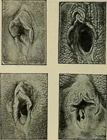 An illustration from Grundriss und Atlas der allgemeinen Chirurgie (1905)