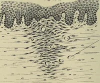 An illustration from Grundriss und Atlas der allgemeinen Chirurgie (1905)