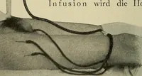 Picture 28 of 110 from Grundriss und Atlas der allgemeinen Chirurgie (1905), leaf 92