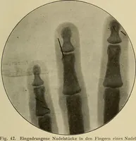 Picture 29 of 110 from Grundriss und Atlas der allgemeinen Chirurgie (1905), leaf 95