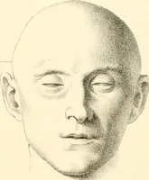 Picture 18 of 27 from Grundzüge der Phrenologie; oder, Anleitung zum Studium dieser Wissenschaft, mit Berücksichtigung der neueren Forschungen auf dem Gebiete der Physiologie und Psychologie (1856), leaf 624