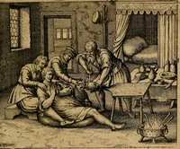 An illustration from Guilhelmi FabricI Hildani inclytae reipublicae Bernensis Helvet. medico-chirurgi ordinarii De gangraena et sphacelo, tractatus methodicus : in quo horum morborum differentiae, causae, signa, prognostica, ac denique methodica curatio continentur (1617)