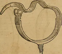An illustration from Guilhelmi FabricI Hildani inclytae reipublicae Bernensis Helvet. medico-chirurgi ordinarii De gangraena et sphacelo, tractatus methodicus : in quo horum morborum differentiae, causae, signa, prognostica, ac denique methodica curatio continentur (1617)