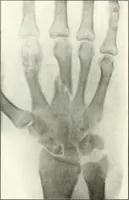 An illustration from Gunshot Roentgenograms : Acollection of Roentgenograms taken in Constantinople during the Turko-Balkan War, 1912-1913, illustrating some gunshot wounds in the Turkish Army (1916)