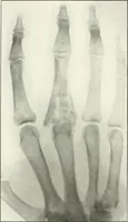 An illustration from Gunshot Roentgenograms : Acollection of Roentgenograms taken in Constantinople during the Turko-Balkan War, 1912-1913, illustrating some gunshot wounds in the Turkish Army (1916)