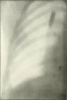 An illustration from Gunshot Roentgenograms : Acollection of Roentgenograms taken in Constantinople during the Turko-Balkan War, 1912-1913, illustrating some gunshot wounds in the Turkish Army (1916)