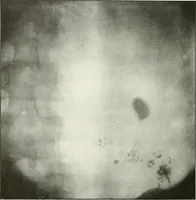 An illustration from Gunshot Roentgenograms : Acollection of Roentgenograms taken in Constantinople during the Turko-Balkan War, 1912-1913, illustrating some gunshot wounds in the Turkish Army (1916)