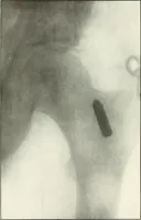 An illustration from Gunshot Roentgenograms : Acollection of Roentgenograms taken in Constantinople during the Turko-Balkan War, 1912-1913, illustrating some gunshot wounds in the Turkish Army (1916)