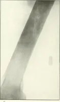 An illustration from Gunshot Roentgenograms : Acollection of Roentgenograms taken in Constantinople during the Turko-Balkan War, 1912-1913, illustrating some gunshot wounds in the Turkish Army (1916)
