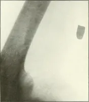 An illustration from Gunshot Roentgenograms : Acollection of Roentgenograms taken in Constantinople during the Turko-Balkan War, 1912-1913, illustrating some gunshot wounds in the Turkish Army (1916)