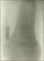 An illustration from Gunshot Roentgenograms : Acollection of Roentgenograms taken in Constantinople during the Turko-Balkan War, 1912-1913, illustrating some gunshot wounds in the Turkish Army (1916)