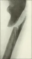 An illustration from Gunshot Roentgenograms : Acollection of Roentgenograms taken in Constantinople during the Turko-Balkan War, 1912-1913, illustrating some gunshot wounds in the Turkish Army (1916)