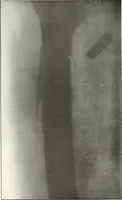 An illustration from Gunshot Roentgenograms : Acollection of Roentgenograms taken in Constantinople during the Turko-Balkan War, 1912-1913, illustrating some gunshot wounds in the Turkish Army (1916)