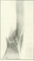 An illustration from Gunshot Roentgenograms : Acollection of Roentgenograms taken in Constantinople during the Turko-Balkan War, 1912-1913, illustrating some gunshot wounds in the Turkish Army (1916)