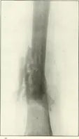 An illustration from Gunshot Roentgenograms : Acollection of Roentgenograms taken in Constantinople during the Turko-Balkan War, 1912-1913, illustrating some gunshot wounds in the Turkish Army (1916)