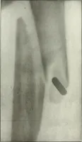 An illustration from Gunshot Roentgenograms : Acollection of Roentgenograms taken in Constantinople during the Turko-Balkan War, 1912-1913, illustrating some gunshot wounds in the Turkish Army (1916)