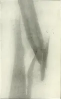 An illustration from Gunshot Roentgenograms : Acollection of Roentgenograms taken in Constantinople during the Turko-Balkan War, 1912-1913, illustrating some gunshot wounds in the Turkish Army (1916)