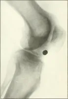 An illustration from Gunshot Roentgenograms : Acollection of Roentgenograms taken in Constantinople during the Turko-Balkan War, 1912-1913, illustrating some gunshot wounds in the Turkish Army (1916)