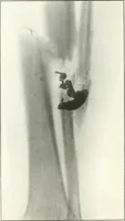 An illustration from Gunshot Roentgenograms : Acollection of Roentgenograms taken in Constantinople during the Turko-Balkan War, 1912-1913, illustrating some gunshot wounds in the Turkish Army (1916)