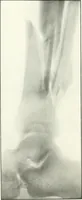 An illustration from Gunshot Roentgenograms : Acollection of Roentgenograms taken in Constantinople during the Turko-Balkan War, 1912-1913, illustrating some gunshot wounds in the Turkish Army (1916)