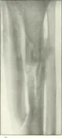 An illustration from Gunshot Roentgenograms : Acollection of Roentgenograms taken in Constantinople during the Turko-Balkan War, 1912-1913, illustrating some gunshot wounds in the Turkish Army (1916)