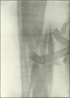 An illustration from Gunshot Roentgenograms : Acollection of Roentgenograms taken in Constantinople during the Turko-Balkan War, 1912-1913, illustrating some gunshot wounds in the Turkish Army (1916)