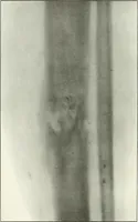 An illustration from Gunshot Roentgenograms : Acollection of Roentgenograms taken in Constantinople during the Turko-Balkan War, 1912-1913, illustrating some gunshot wounds in the Turkish Army (1916)