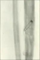 An illustration from Gunshot Roentgenograms : Acollection of Roentgenograms taken in Constantinople during the Turko-Balkan War, 1912-1913, illustrating some gunshot wounds in the Turkish Army (1916)