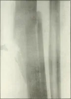 An illustration from Gunshot Roentgenograms : Acollection of Roentgenograms taken in Constantinople during the Turko-Balkan War, 1912-1913, illustrating some gunshot wounds in the Turkish Army (1916)