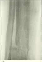 An illustration from Gunshot Roentgenograms : Acollection of Roentgenograms taken in Constantinople during the Turko-Balkan War, 1912-1913, illustrating some gunshot wounds in the Turkish Army (1916)