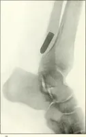 An illustration from Gunshot Roentgenograms : Acollection of Roentgenograms taken in Constantinople during the Turko-Balkan War, 1912-1913, illustrating some gunshot wounds in the Turkish Army (1916)