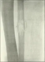An illustration from Gunshot Roentgenograms : Acollection of Roentgenograms taken in Constantinople during the Turko-Balkan War, 1912-1913, illustrating some gunshot wounds in the Turkish Army (1916)