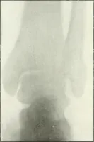 An illustration from Gunshot Roentgenograms : Acollection of Roentgenograms taken in Constantinople during the Turko-Balkan War, 1912-1913, illustrating some gunshot wounds in the Turkish Army (1916)