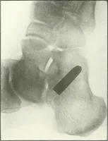An illustration from Gunshot Roentgenograms : Acollection of Roentgenograms taken in Constantinople during the Turko-Balkan War, 1912-1913, illustrating some gunshot wounds in the Turkish Army (1916)