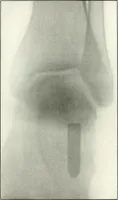 An illustration from Gunshot Roentgenograms : Acollection of Roentgenograms taken in Constantinople during the Turko-Balkan War, 1912-1913, illustrating some gunshot wounds in the Turkish Army (1916)