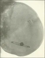 An illustration from Gunshot Roentgenograms : Acollection of Roentgenograms taken in Constantinople during the Turko-Balkan War, 1912-1913, illustrating some gunshot wounds in the Turkish Army (1916)
