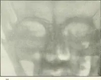An illustration from Gunshot Roentgenograms : Acollection of Roentgenograms taken in Constantinople during the Turko-Balkan War, 1912-1913, illustrating some gunshot wounds in the Turkish Army (1916)