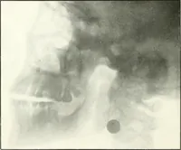 An illustration from Gunshot Roentgenograms : Acollection of Roentgenograms taken in Constantinople during the Turko-Balkan War, 1912-1913, illustrating some gunshot wounds in the Turkish Army (1916)