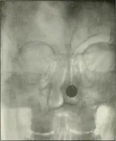 An illustration from Gunshot Roentgenograms : Acollection of Roentgenograms taken in Constantinople during the Turko-Balkan War, 1912-1913, illustrating some gunshot wounds in the Turkish Army (1916)