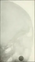 An illustration from Gunshot Roentgenograms : Acollection of Roentgenograms taken in Constantinople during the Turko-Balkan War, 1912-1913, illustrating some gunshot wounds in the Turkish Army (1916)