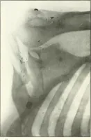 An illustration from Gunshot Roentgenograms : Acollection of Roentgenograms taken in Constantinople during the Turko-Balkan War, 1912-1913, illustrating some gunshot wounds in the Turkish Army (1916)